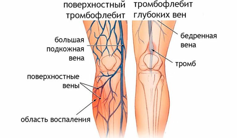Симптомы тромбофлебита глубоких вен и поверхностного