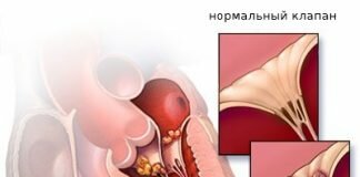симптомы и классификация септического эндокардита