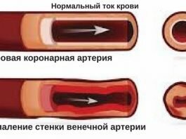 симптомы и лечение миокардита абрамова