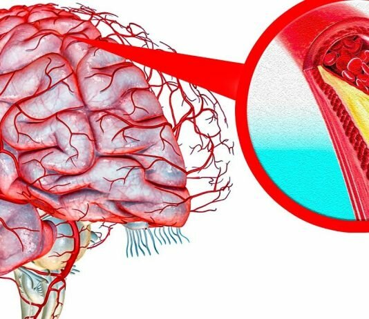 как почистить сосуды головного мозга